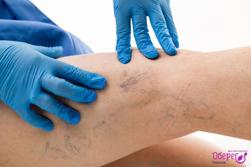 Характерные симптомы варикоза